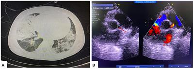 Multisystemic Inflammatory Syndrome and Thrombotic Microangiopathy as Complications of COVID-19 in a Child: A Case Report